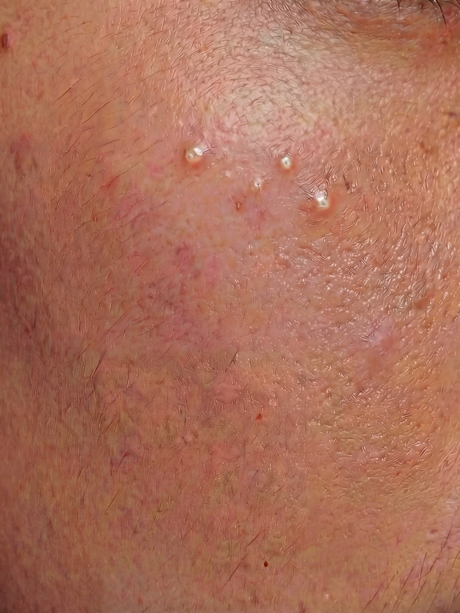 Acne-Prone Skin