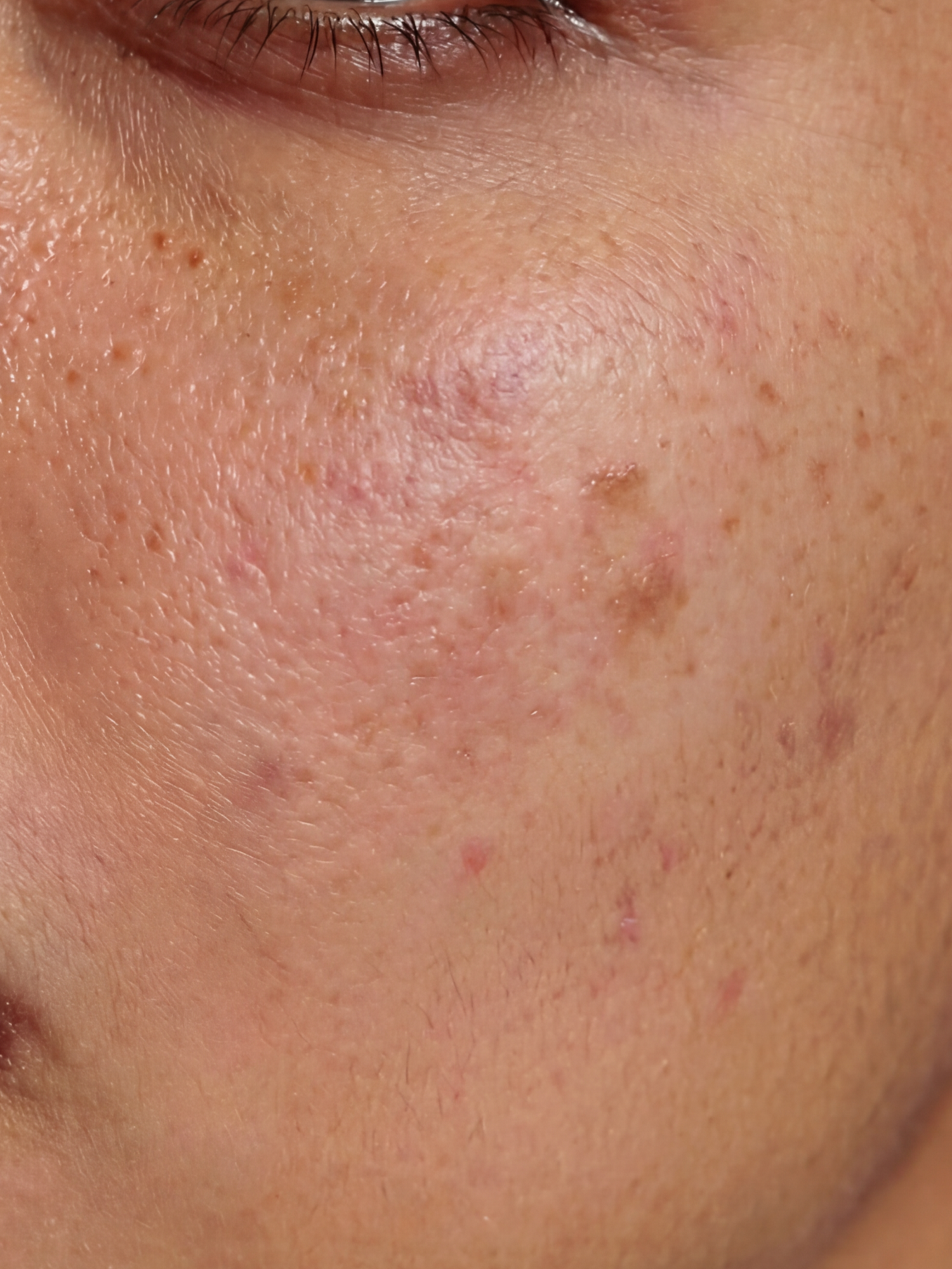 Uneven Skin tone